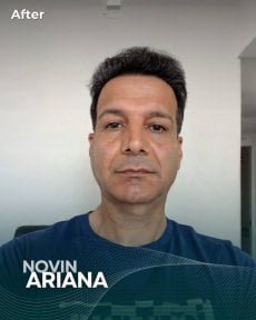 After Sapphire FUE hair transplant result at NOVİN ARİANA SAĞLIK VE TURİZM LİMİTED ŞİRKETİ