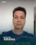 After Sapphire FUE hair transplant result at NOVİN ARİANA SAĞLIK VE TURİZM LİMİTED ŞİRKETİ