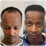 Before and after Sapphire FUE hair transplant result at NOVİN ARİANA SAĞLIK VE TURİZM clinic