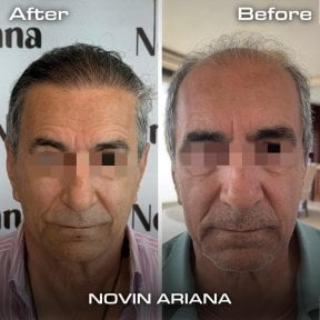 Before and after Sapphire FUE hair transplant result at NOVİN ARİANA SAĞLIK VE TURİZM clinic