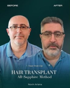 Before and after Sapphire FUE hair transplant result at NOVİN ARİANA SAĞLIK VE TURİZM clinic