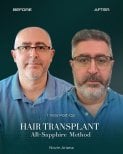 Before and after Sapphire FUE hair transplant result at NOVİN ARİANA SAĞLIK VE TURİZM clinic