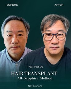Before and after Sapphire FUE hair transplant result at NOVİN ARİANA SAĞLIK clinic, 1 year post-op