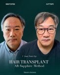Before and after Sapphire FUE hair transplant result at NOVİN ARİANA SAĞLIK clinic, 1 year post-op