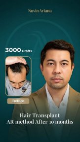 Sapphire FUE hair transplant before and after results at NOVİN ARİANA, 3000 grafts, 10 months
