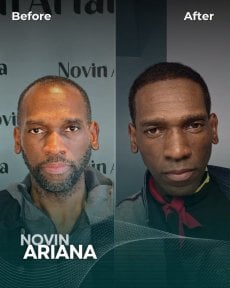 Before and after Sapphire FUE hair transplant result at NOVİN ARİANA SAĞLIK VE TURİZM clinic