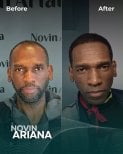 Before and after Sapphire FUE hair transplant result at NOVİN ARİANA SAĞLIK VE TURİZM clinic