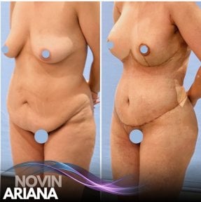before-after photo breast-reduction