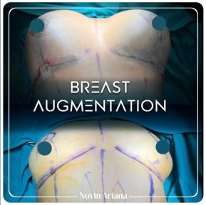 before-after photo breast-reduction