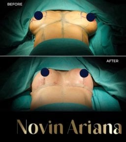 before-after photo breast-reduction