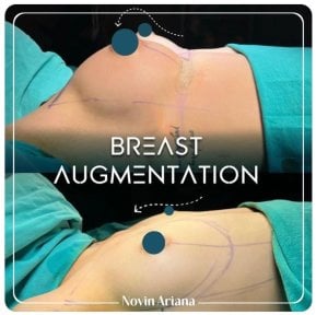 before-after photo breast-reduction