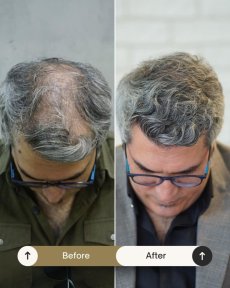 Before and after FUE hair transplant result at NOVİN ARİANA SAĞLIK VE TURİZM LİMİTED ŞİRKETİ
