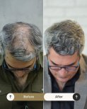 Before and after FUE hair transplant result at NOVİN ARİANA SAĞLIK VE TURİZM LİMİTED ŞİRKETİ