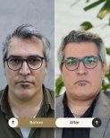 Before and after FUE hair transplant result at NOVİN ARİANA SAĞLIK VE TURİZM LİMİTED ŞİRKETİ