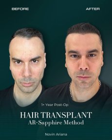 Before and after FUE hair transplant result at NOVİN ARİANA SAĞLIK, fuller hairline shown