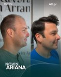 Before and after FUE hair transplant result at NOVİN ARİANA SAĞLIK, restored hairline