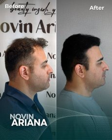 Before and after FUE hair transplant results at NOVİN ARİANA SAĞLIK VE TURİZM LİMİTED ŞİRKETİ