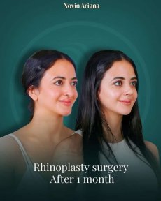 before-after photo revision-rhinoplasty