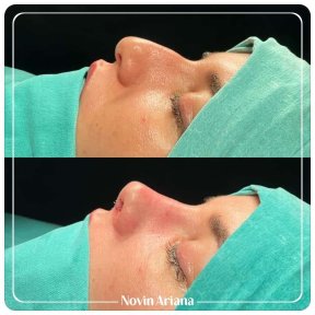 before-after photo revision-rhinoplasty
