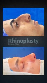 before-after photo revision-rhinoplasty