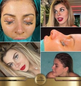 before-after photo revision-rhinoplasty