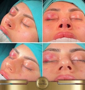before-after photo revision-rhinoplasty