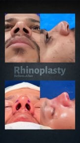 before-after photo revision-rhinoplasty