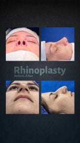 before-after photo revision-rhinoplasty