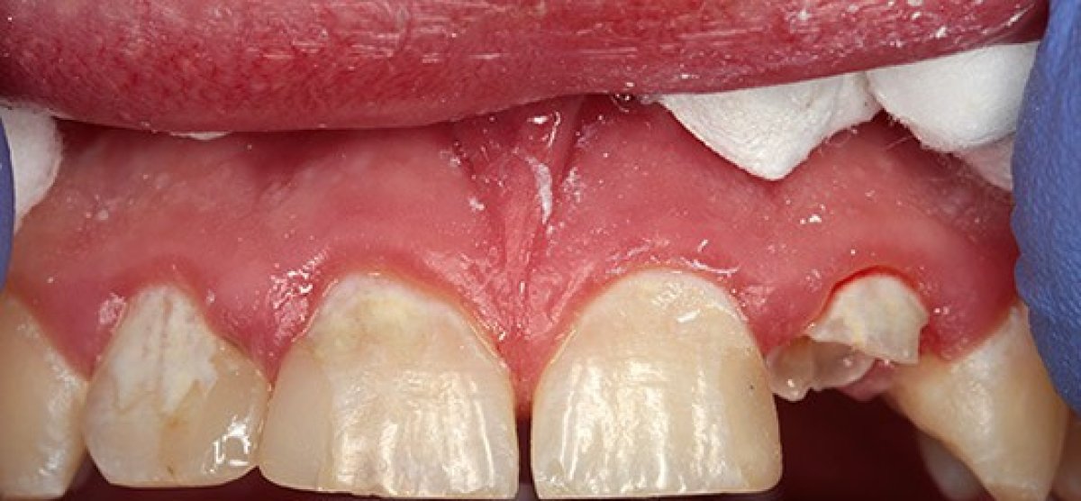 Resultado del tratamiento de caries en clínica dental: daño dental visible antes de restaurar