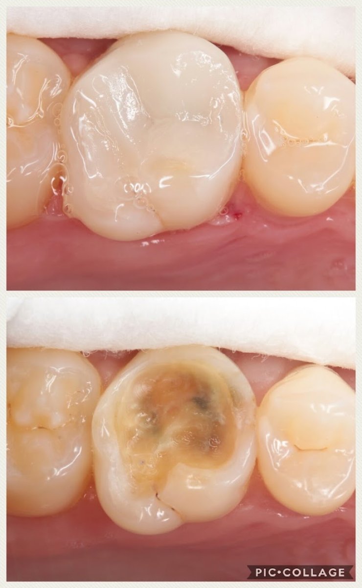 Resultado antes y después de empaste compuesto: restauración dental de aspecto natural