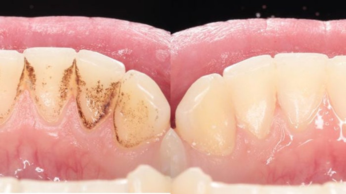 Resultados antes y después de limpieza dental profunda (raspado y alisado radicular) – eliminación de placa