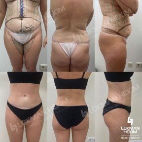 before-after photo abdominal-liposuction