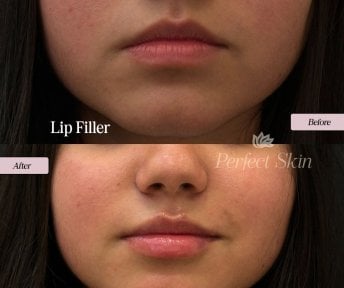 before-after photo fillers-injection