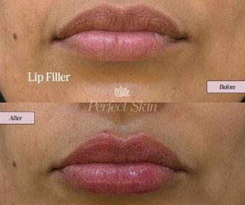 before-after photo fillers-injection