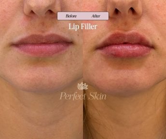before-after photo fillers-injection