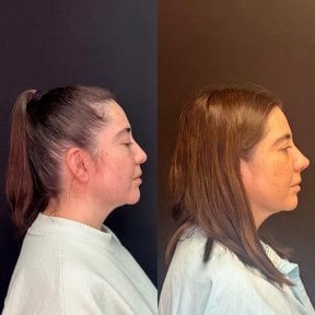 before-after photo revision-rhinoplasty