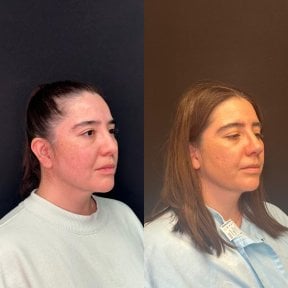 before-after photo revision-rhinoplasty