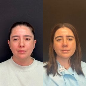 before-after photo revision-rhinoplasty