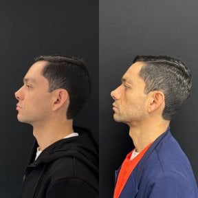 before-after photo revision-rhinoplasty