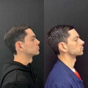 before-after photo revision-rhinoplasty