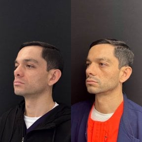 before-after photo revision-rhinoplasty
