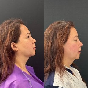 before-after photo revision-rhinoplasty