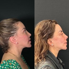before-after photo revision-rhinoplasty