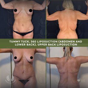 before-after photo breast-augmentation