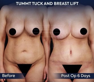 before-after photo breast-augmentation
