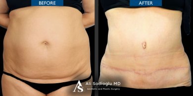 before-after photo breast-augmentation