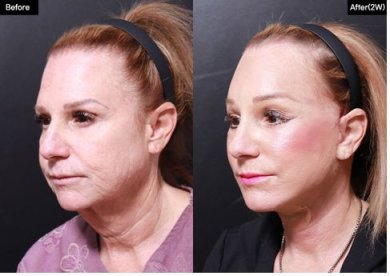 Facelift before and after results at VG Plastic Surgery – visible facial rejuvenation and lift