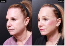 Facelift before and after results at VG Plastic Surgery – visible facial rejuvenation and lift