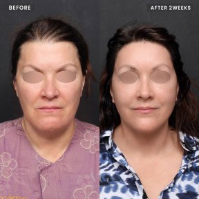 Before and after facelift results at VG Plastic Surgery – visible facial rejuvenation after 2 weeks
