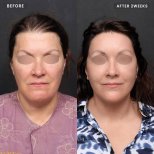 Before and after facelift results at VG Plastic Surgery – visible facial rejuvenation after 2 weeks